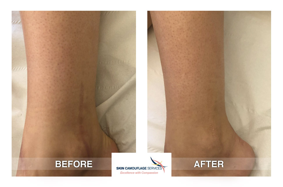 Results skin camouflage results. Before and after longitudinal hyperpigmented scar to the lateral aspect of the ankle.
