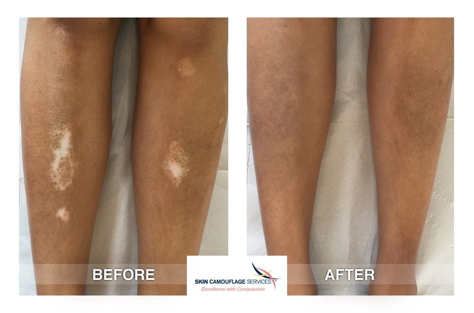 Skin Camouflage for Vitiligo to the lower legs