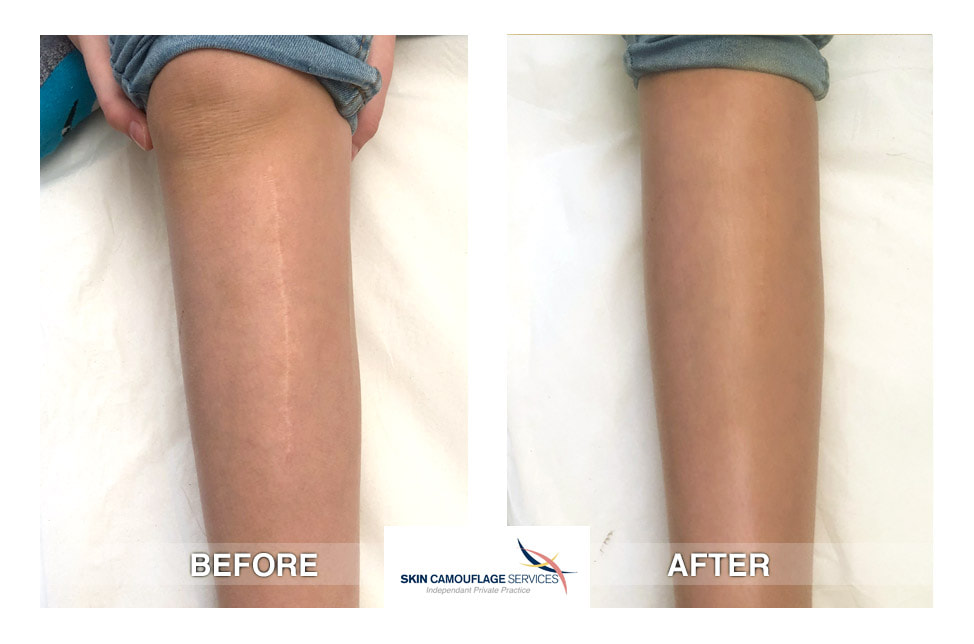 Skin Camouflage for incisional scar over the anteromedial section of the right leg.