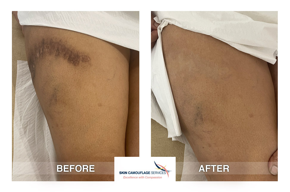 Skin Camouflage Application. Curvilinear hyperpigmented scar with hypertrophic stretching and extensive ‘cross-hatching' consistent with' mattress' sutures