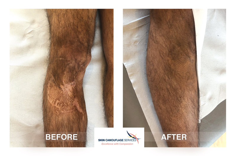 Skin Camouflage Services. Extensive scarring to the right leg