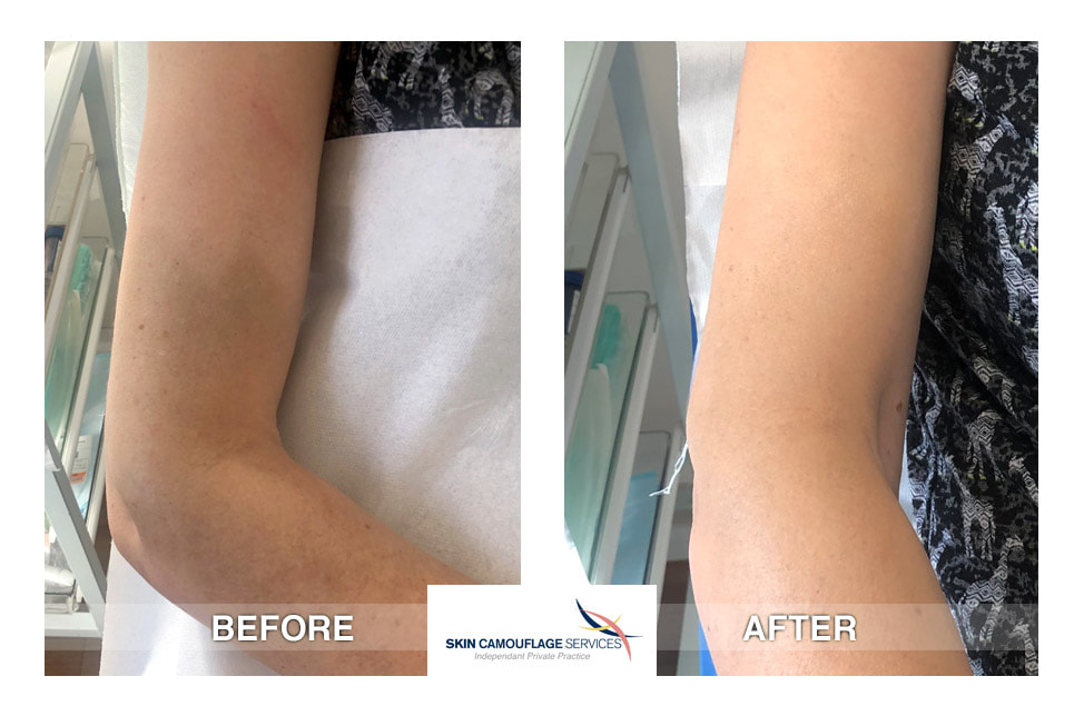Skin camouflage application. An extensive area of altered pigmentation to the right arm.