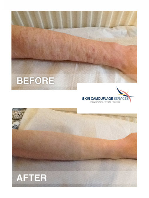 Skin camouflage for self- harm scarring to the forearm