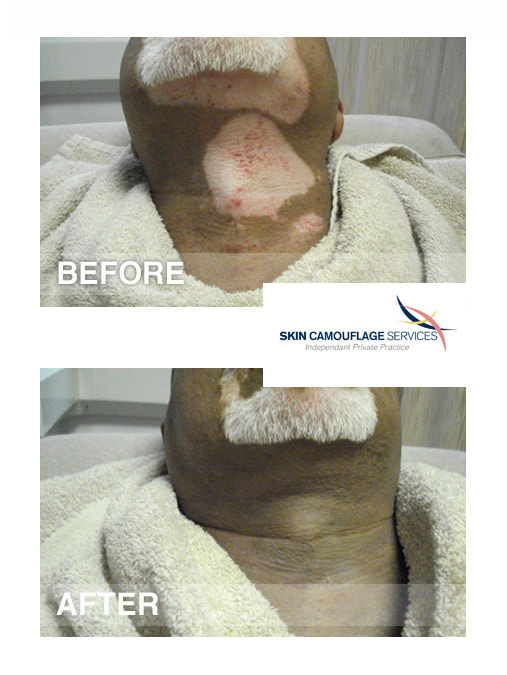 Skin camouflage treatment for vitiligo on the neck