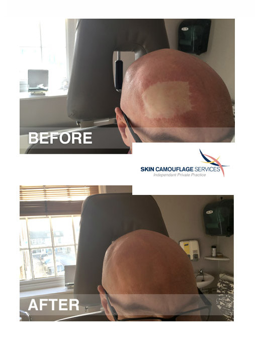 Skin camouflage for a skin graft to the frontal region of the scalp