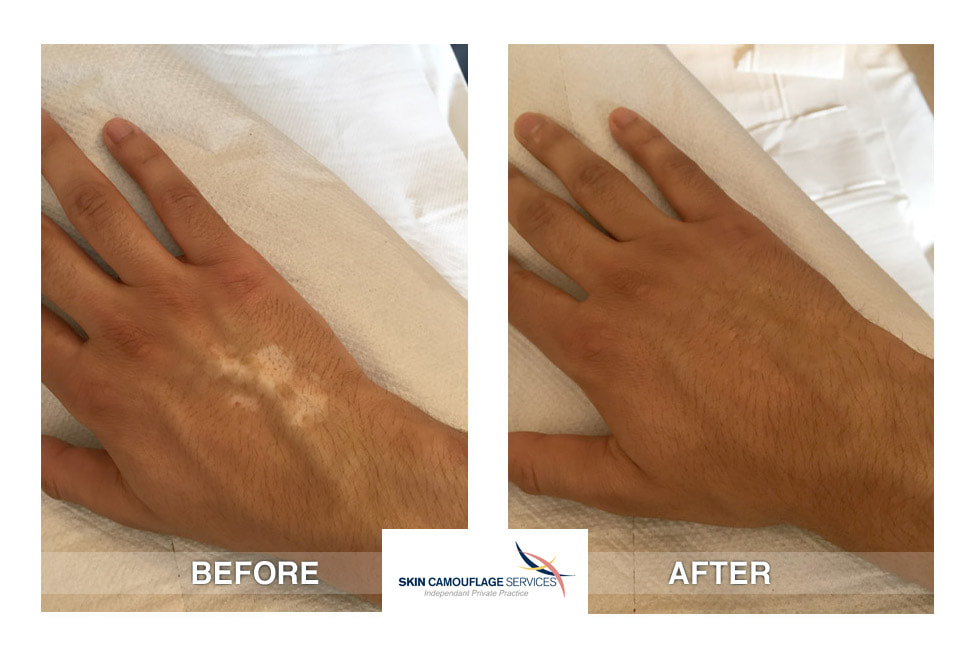 Skin camouflage for hypopigmented scarring on the dorsal surface of the right hand