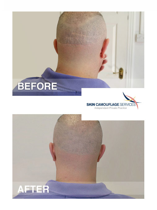 Skin camouflage for linear scarring to the occipital region of the scalp