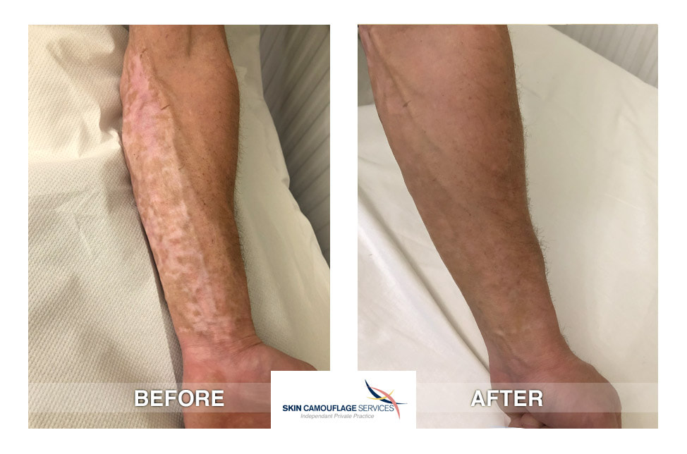 Hypopigmentation and mottling to both the lateral and posterior aspects of the left forearm which extends to the dorsum of the hand.