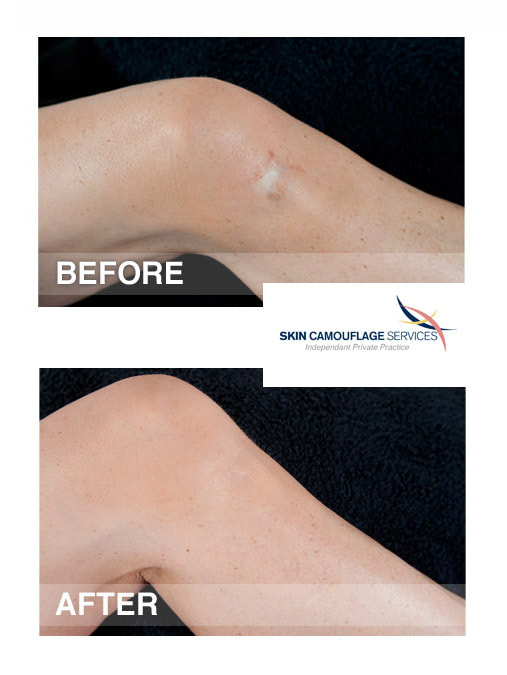 Skin camouflage for pale scarring on lateral aspect of the right knee