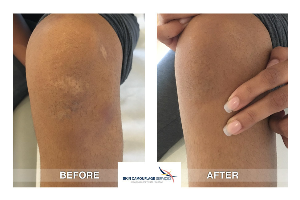 Skin camouflage for scarring on the left knee