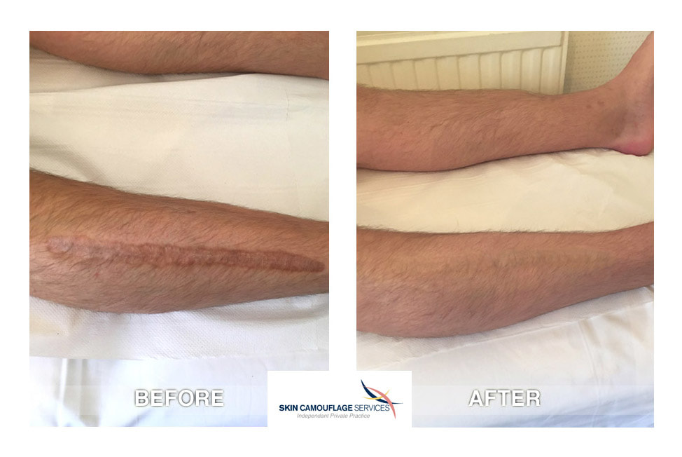Skin camouflage for scarring on the anterior lateral aspect of the right lower leg