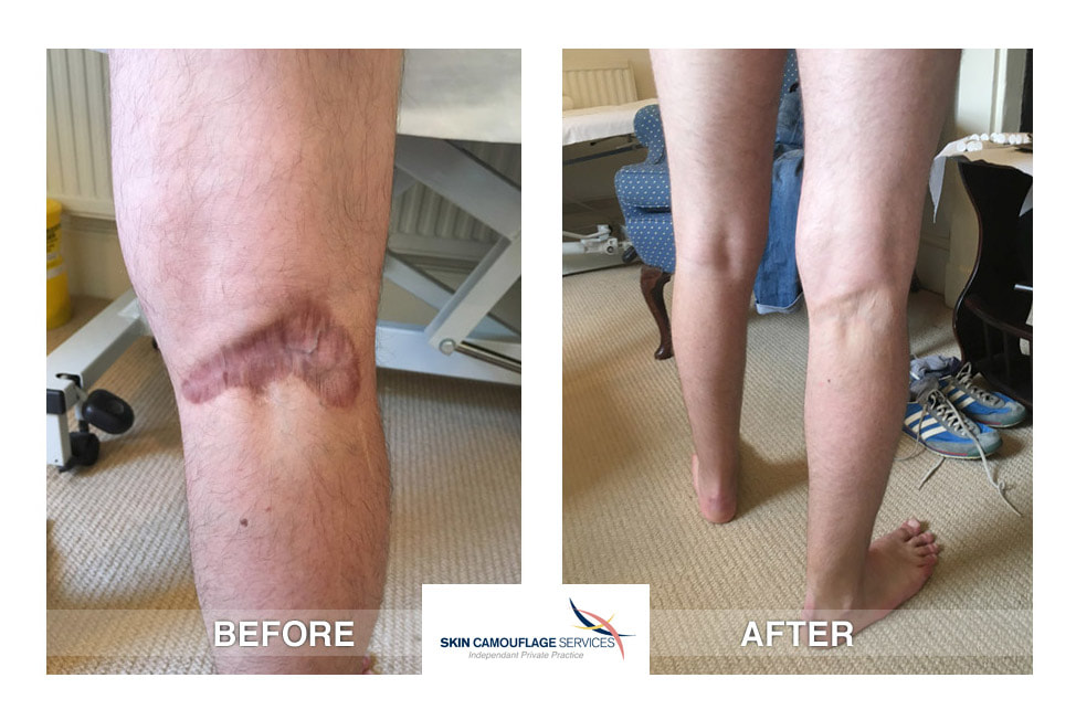 Skin camouflage for complex scarring on the popliteal area of the right lower leg