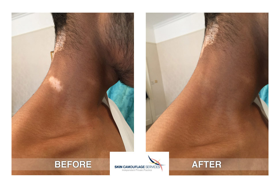 During the skin camouflage treatment for segmental vitiligo on the neck