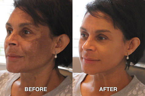 ​Melasma Appointment with Skin Camouflage Services